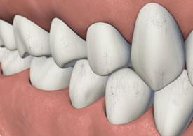 A sample image of craze lines